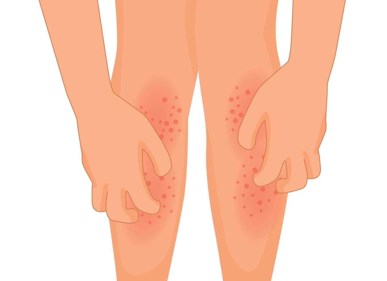 hands scratching itchy leg with rash dry skin because of allergic reaction vector
