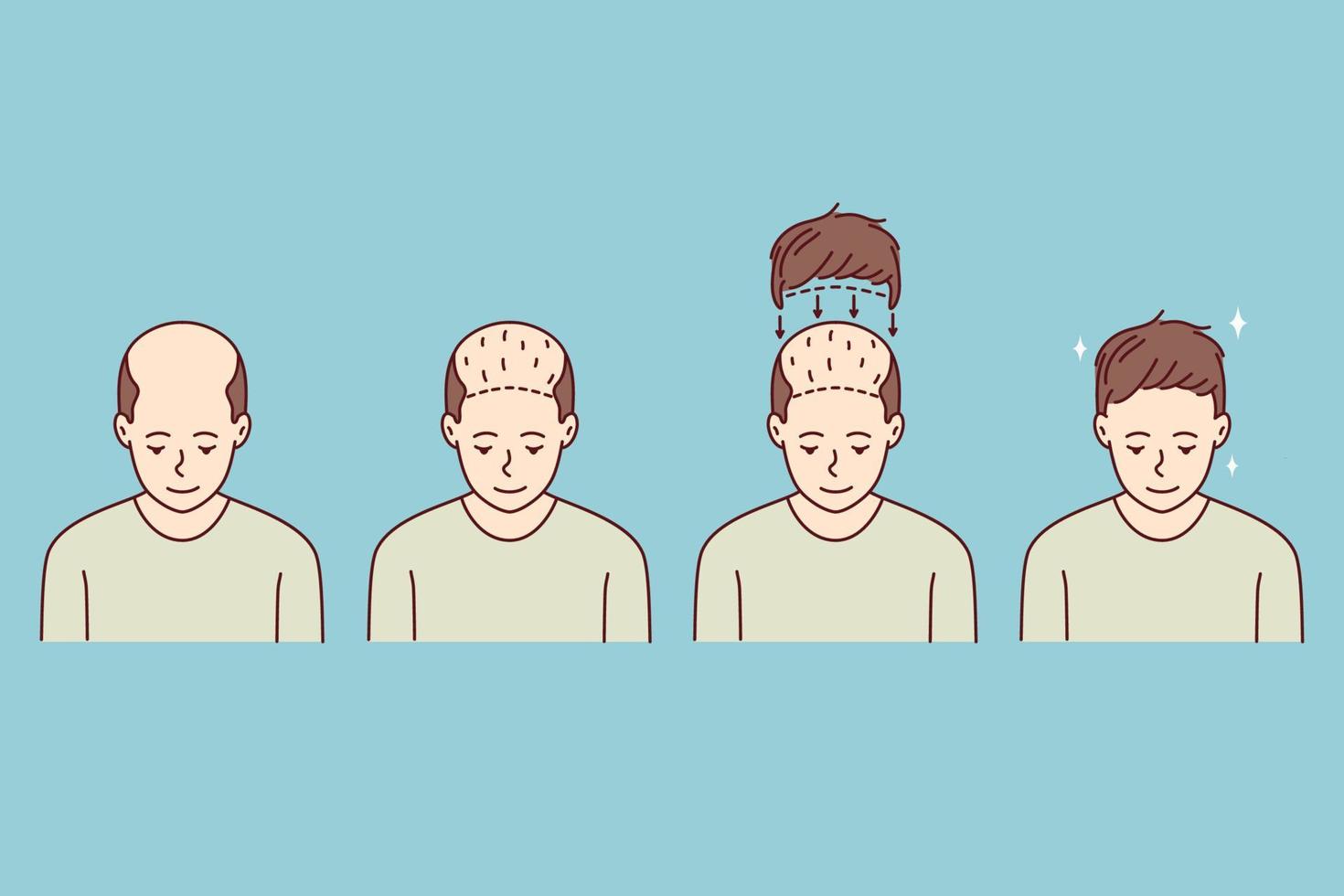 Stages on man hair transplant. Treatment of baldness and alopecia. Set of male patient follicular unit extraction. Vector illustration.
