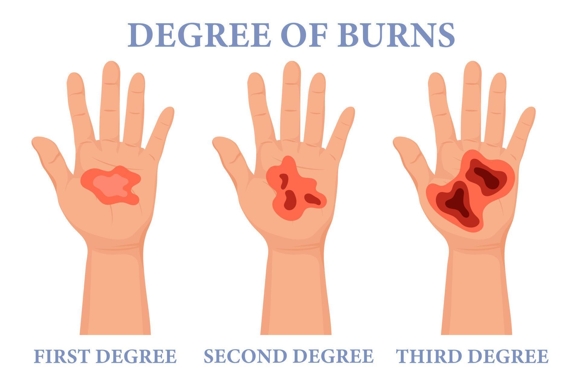 Burn Stages Burnt Hands At Various Degrees Skin Burn Symptoms burn-stages-burnt-hands-at-various-degrees-skin-burn-symptoms