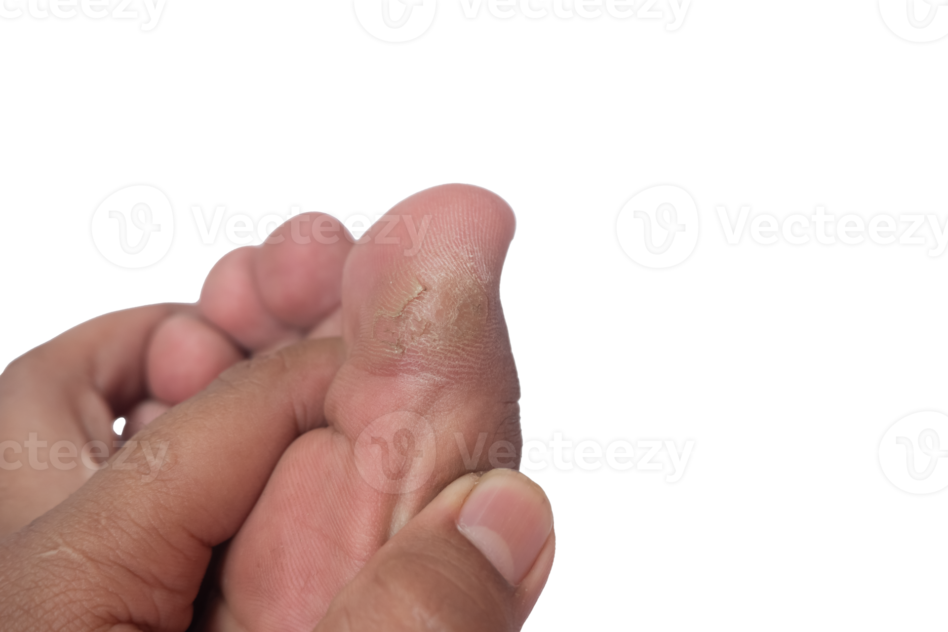 a man's hand showing a callus on the big toe 20389787 PNG