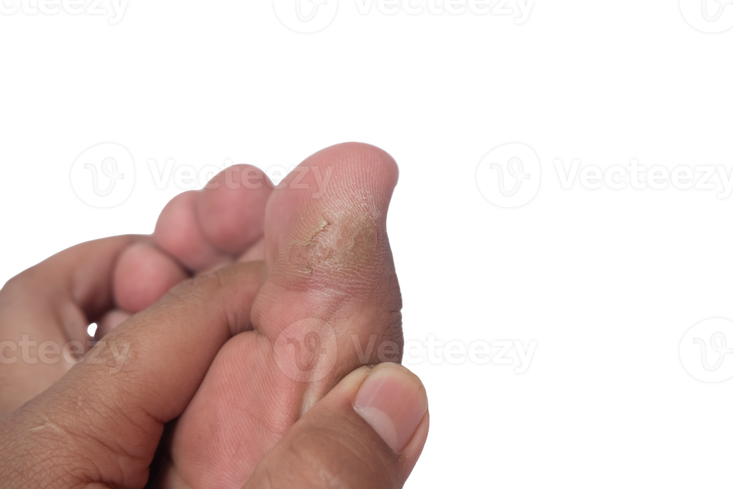 a man's hand showing a callus on the big toe png