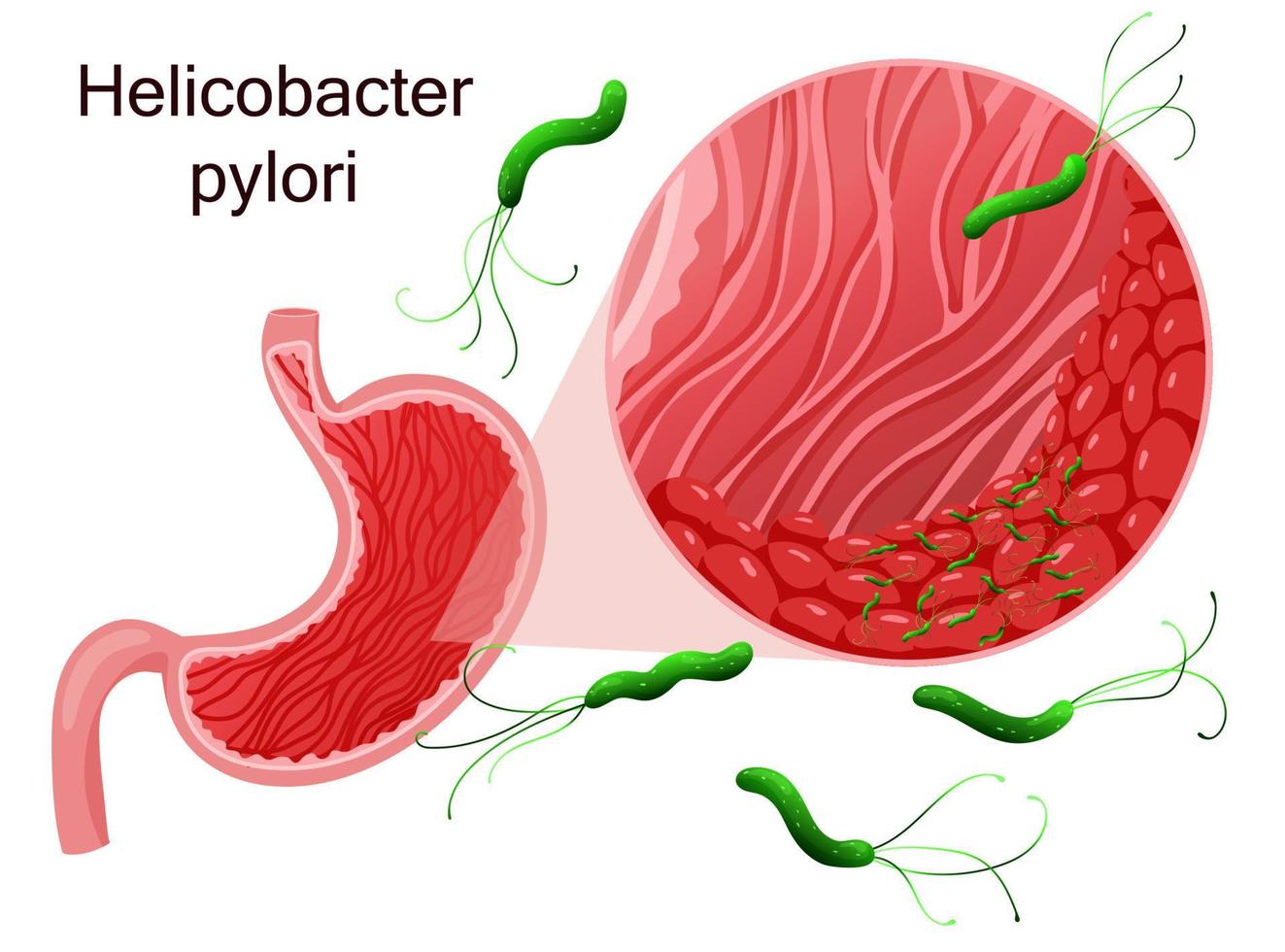 Helicobacter pylori in stomach epithelial cells under magnification. Vector illustration, cartoon style