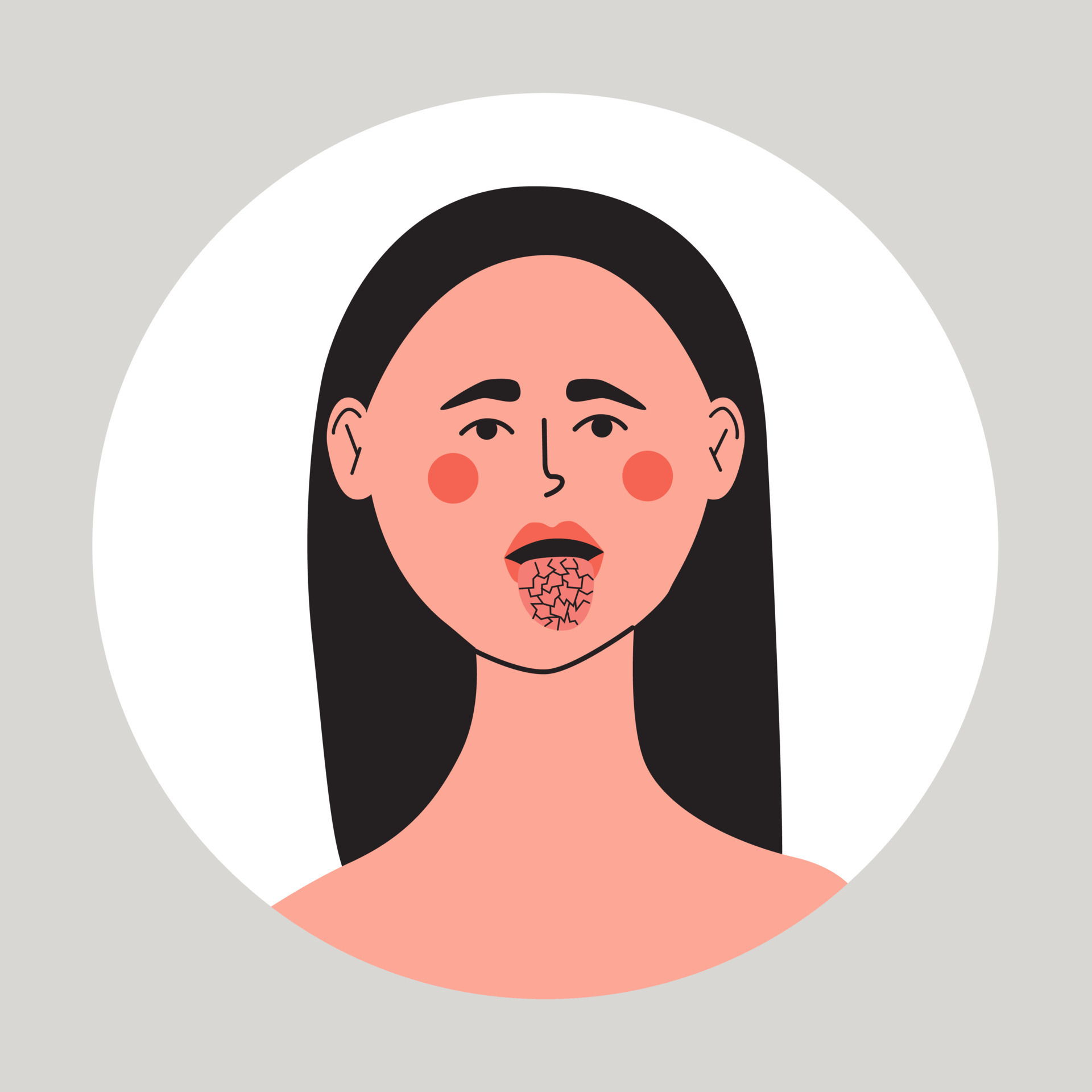 Young woman with dry mouth and tongue, xerostomia problem. 20431502