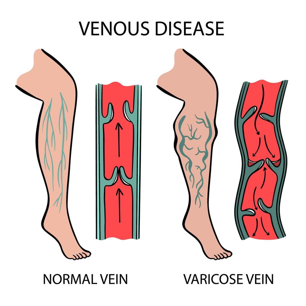 VENOUS DISEASE Varicose Veins Of Human Medicine Education vector