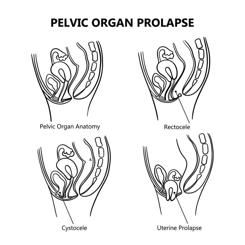 PELVIC ORGAN PROLAPSE VARIOUSLY MONOCHROME Education Vector Set