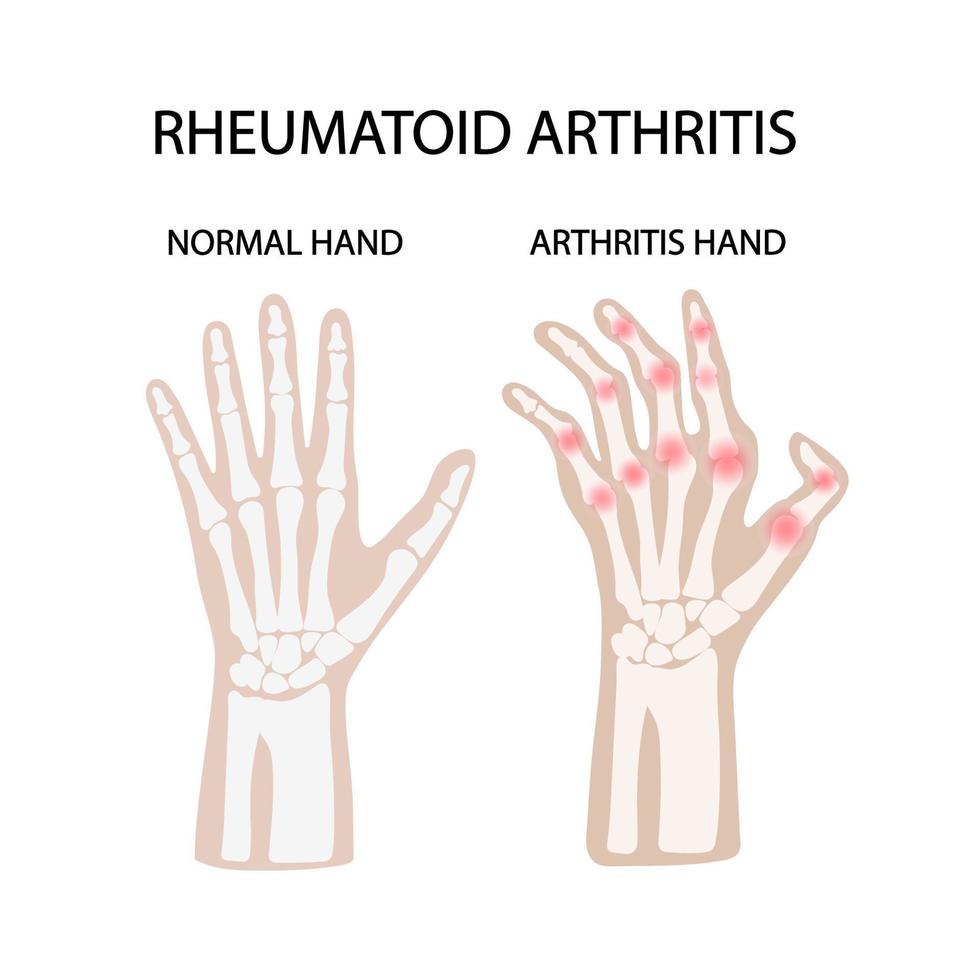 reumatoide artritis lesiones medicina educación vector esquema