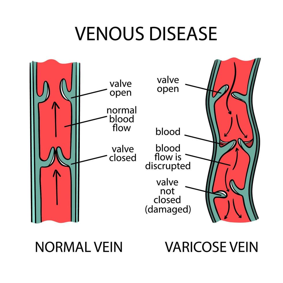 venoso enfermedad esquema varicoso las venas de humano medicina vector
