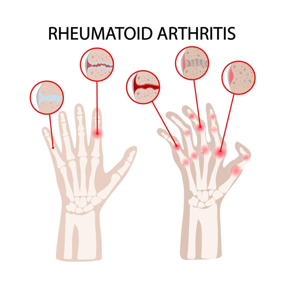 RHEUMATOID ARTHRITIS DISEASE Medicine Education Vector Scheme