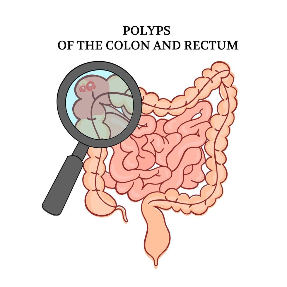 POLYPS OF THE COLON Intestines Medicine Anatomy Vector Scheme