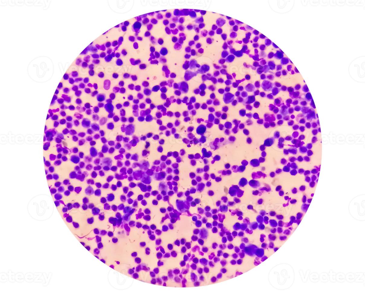Synovial Fluid Cytology, Plenty WBC, microscopic examination of synovial fluid, to diagnose arthritis, particularly for septic or crystal-induced arthritis. photo