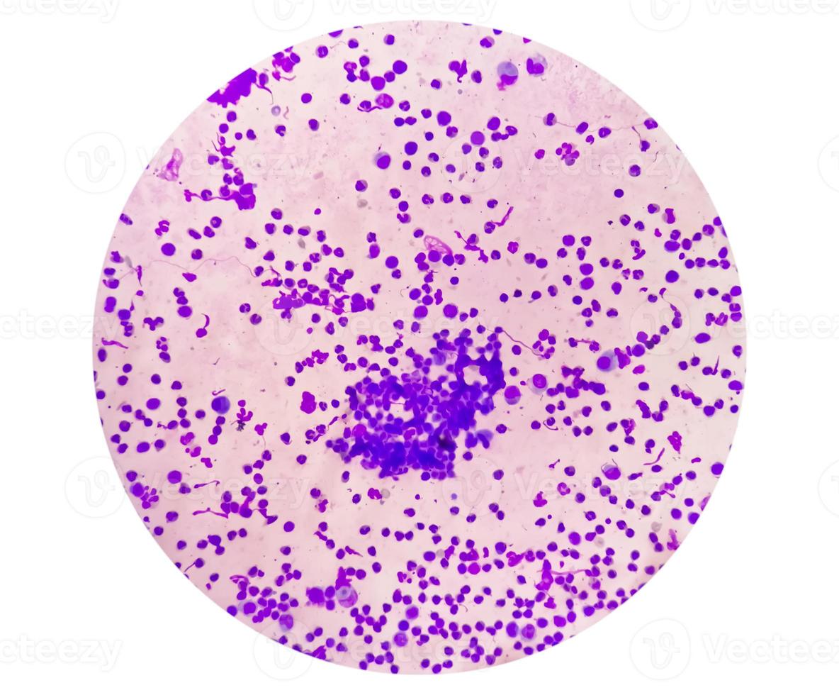 Synovial Fluid Cytology, Plenty WBC, microscopic examination of synovial fluid, to diagnose arthritis, particularly for septic or crystal-induced arthritis. photo