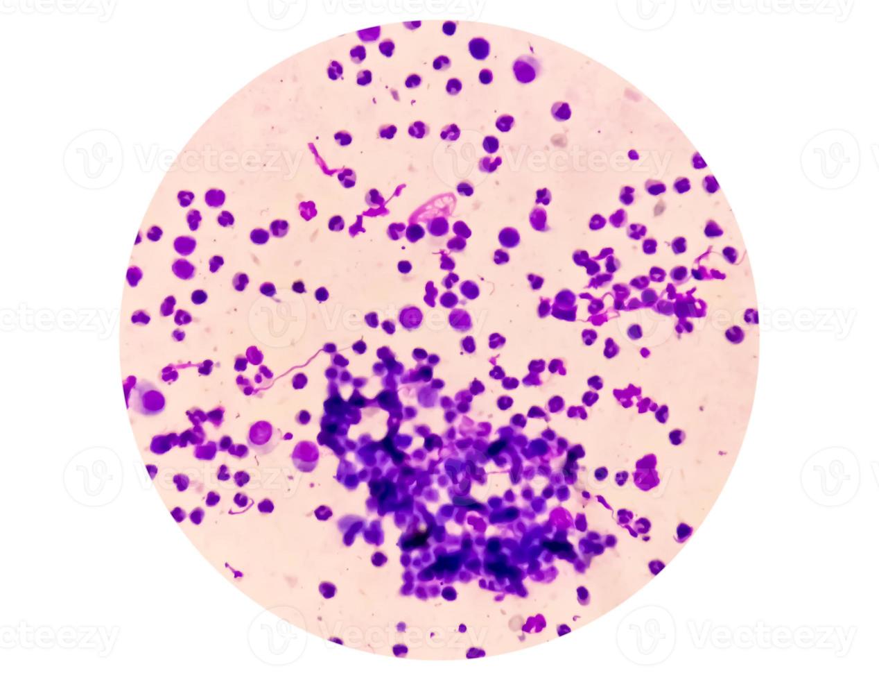 Synovial Fluid Cytology, Plenty WBC, microscopic examination of synovial fluid, to diagnose arthritis, particularly for septic or crystal-induced arthritis. photo