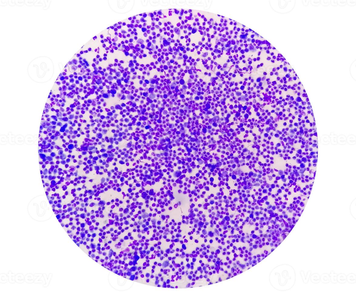 Synovial Fluid Cytology, Plenty WBC, microscopic examination of synovial fluid, to diagnose arthritis, particularly for septic or crystal-induced arthritis. photo