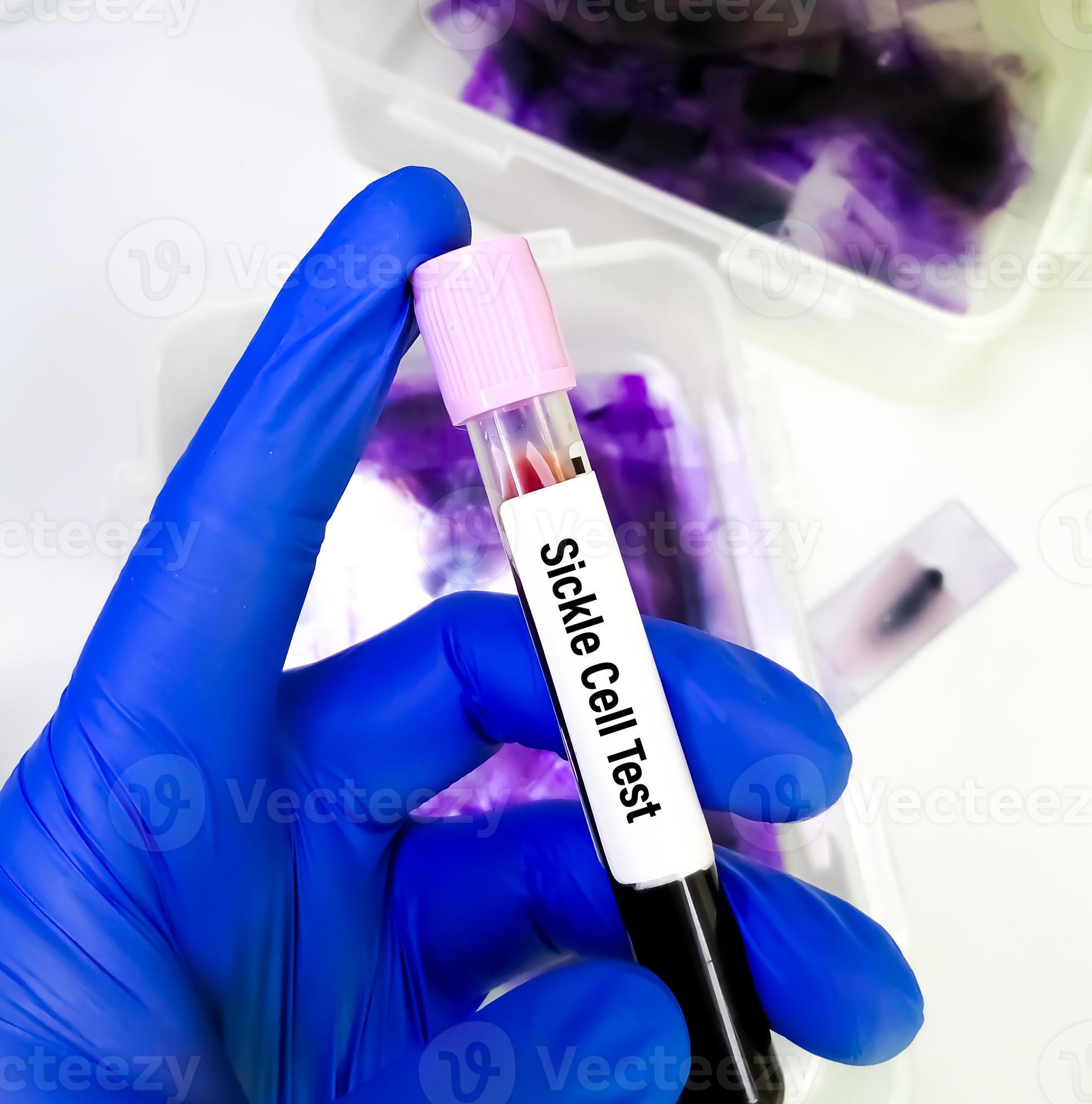 Sickling Test. Sickle Cell disease blood test in doctor hand. 20450258