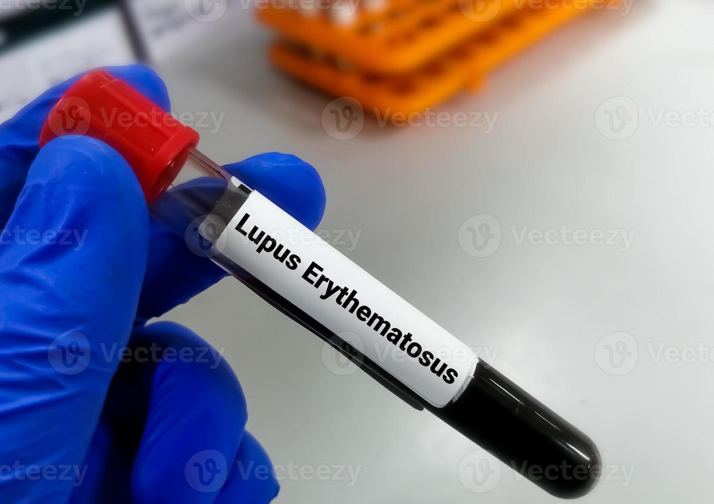 Blood sample for Lupus Erythematosus or LE test, an autoimmune disease in which the immune system attacks its own tissues causing widespread inflammation and tissue damage. photo