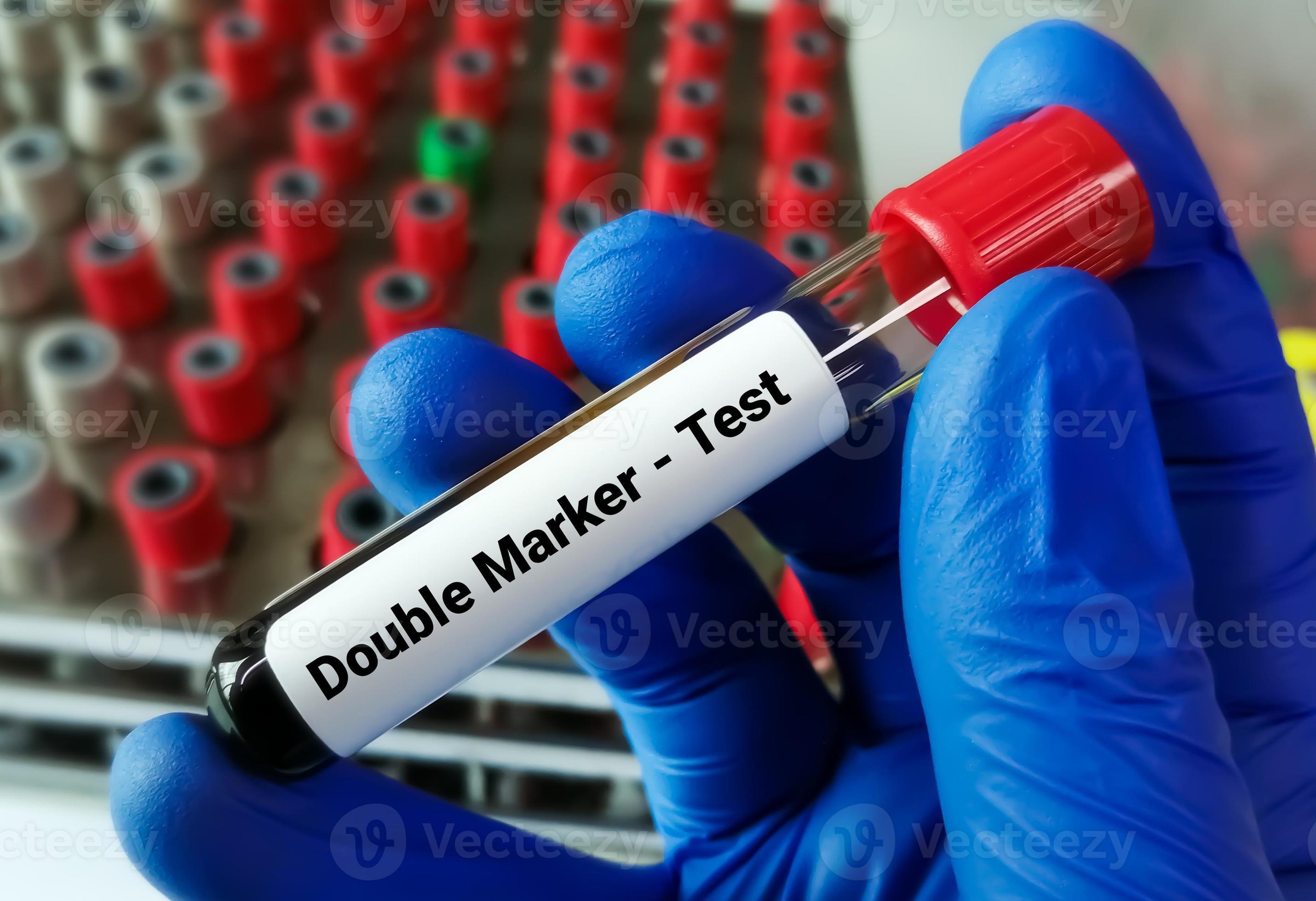 Blood sample for Double Marker Test. Pregnancy marker. 20450269 Stock