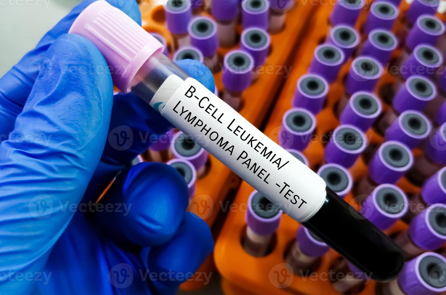 B-cell leukemia or lymphoma panel test, to diagnose leukemia or lymphoma. photo