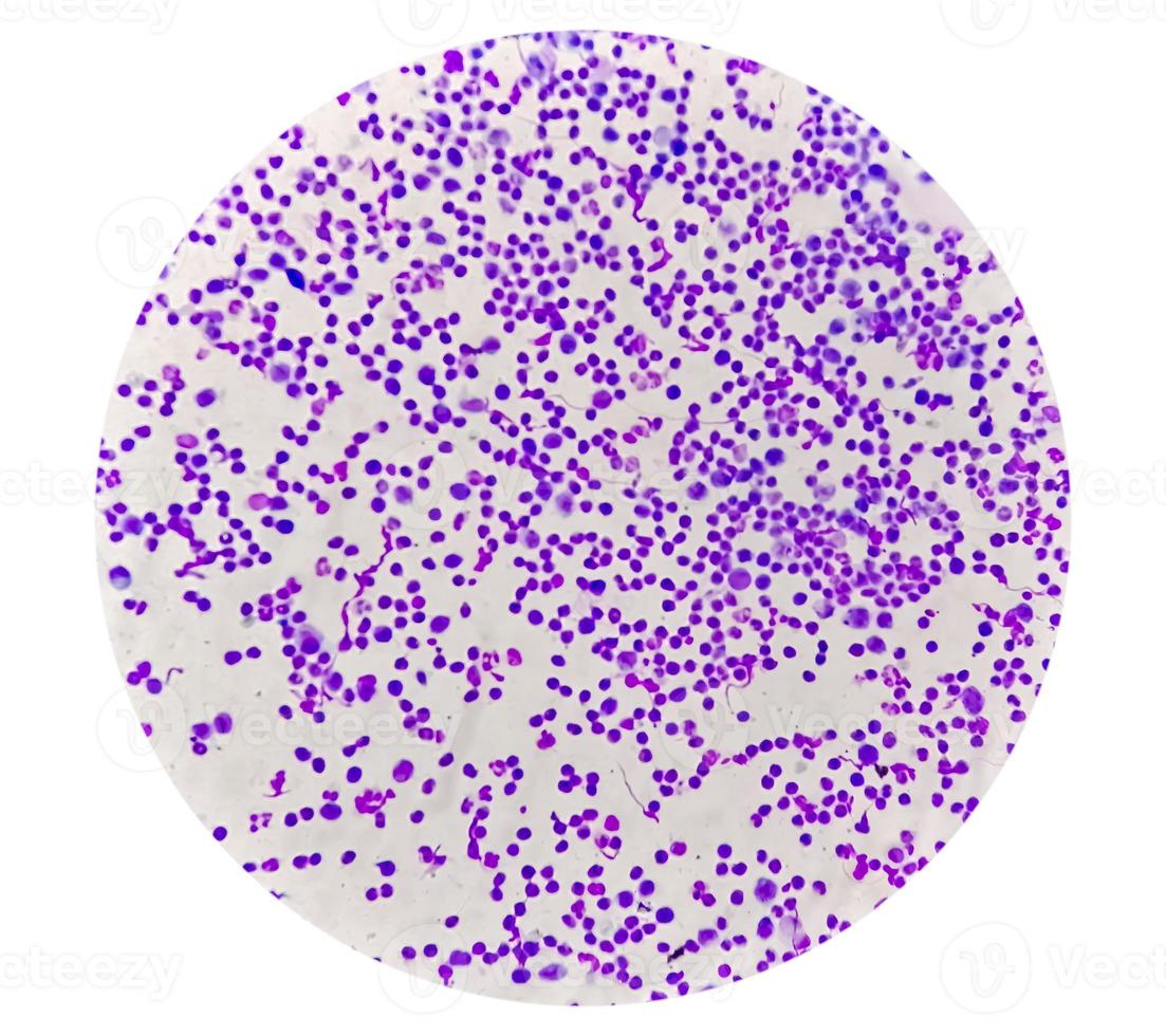 Synovial Fluid Cytology, Plenty WBC, microscopic examination of synovial fluid, to diagnose arthritis, particularly for septic or crystal-induced arthritis. photo