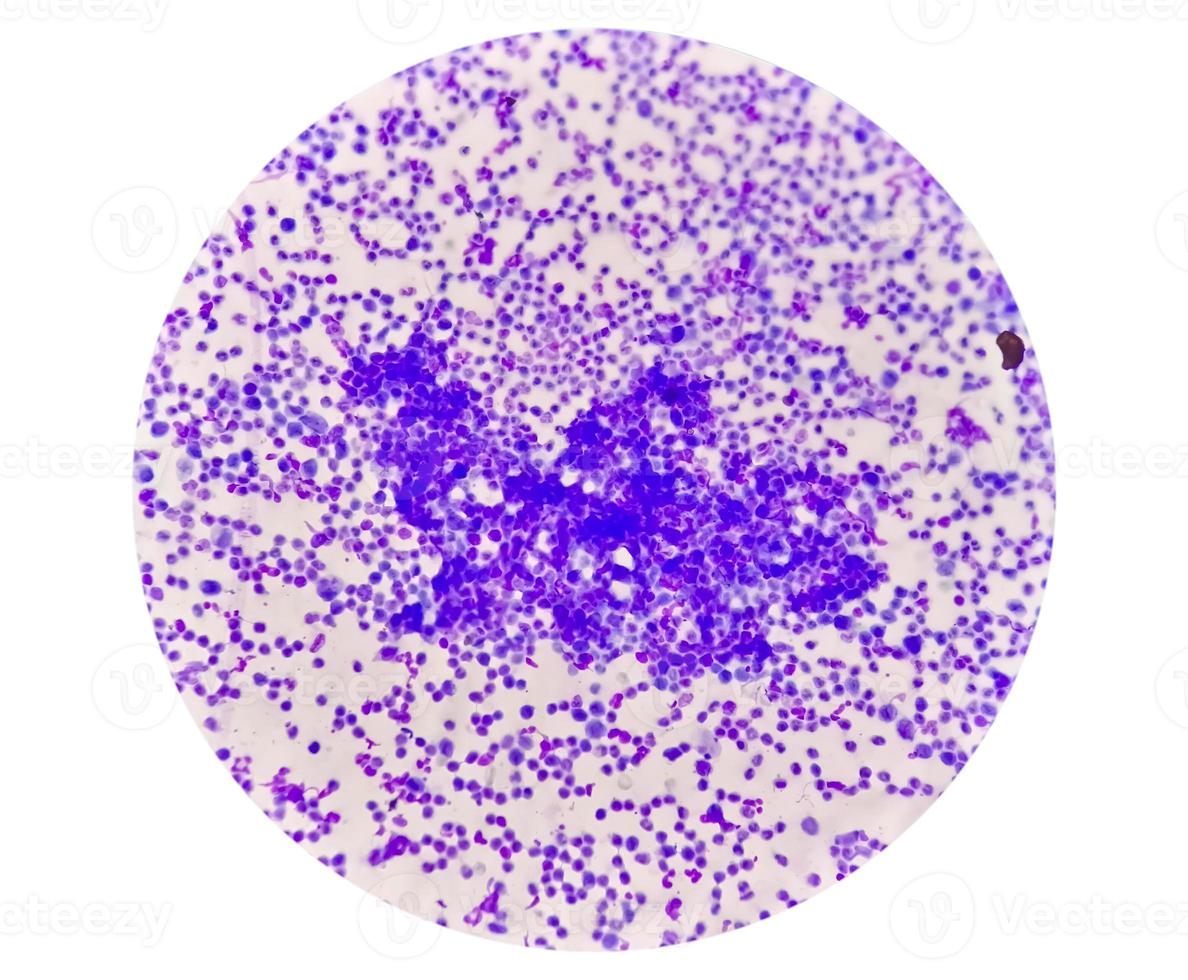 Synovial Fluid Cytology, Plenty WBC, microscopic examination of synovial fluid, to diagnose arthritis, particularly for septic or crystal-induced arthritis. photo