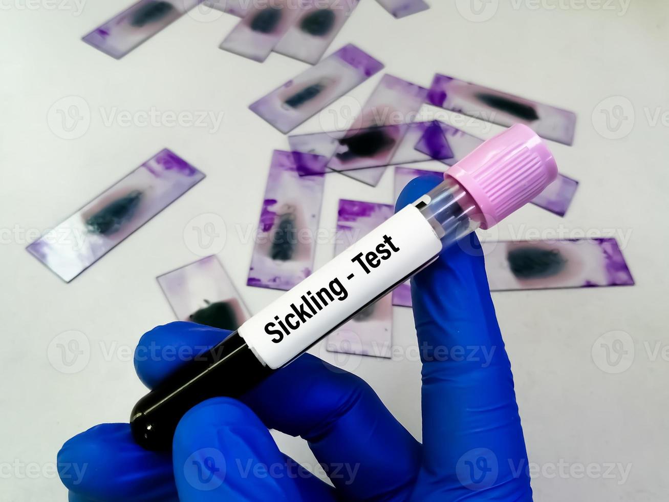 Sickling Test. Sickle Cell disease blood test in doctor hand. photo