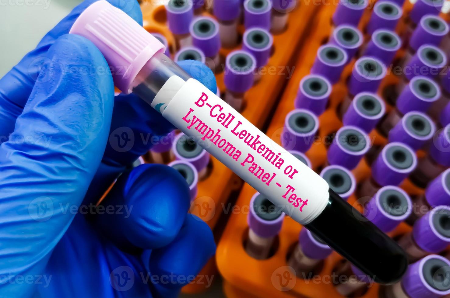 B-cell leukemia or lymphoma panel test, to diagnose leukemia or lymphoma. photo