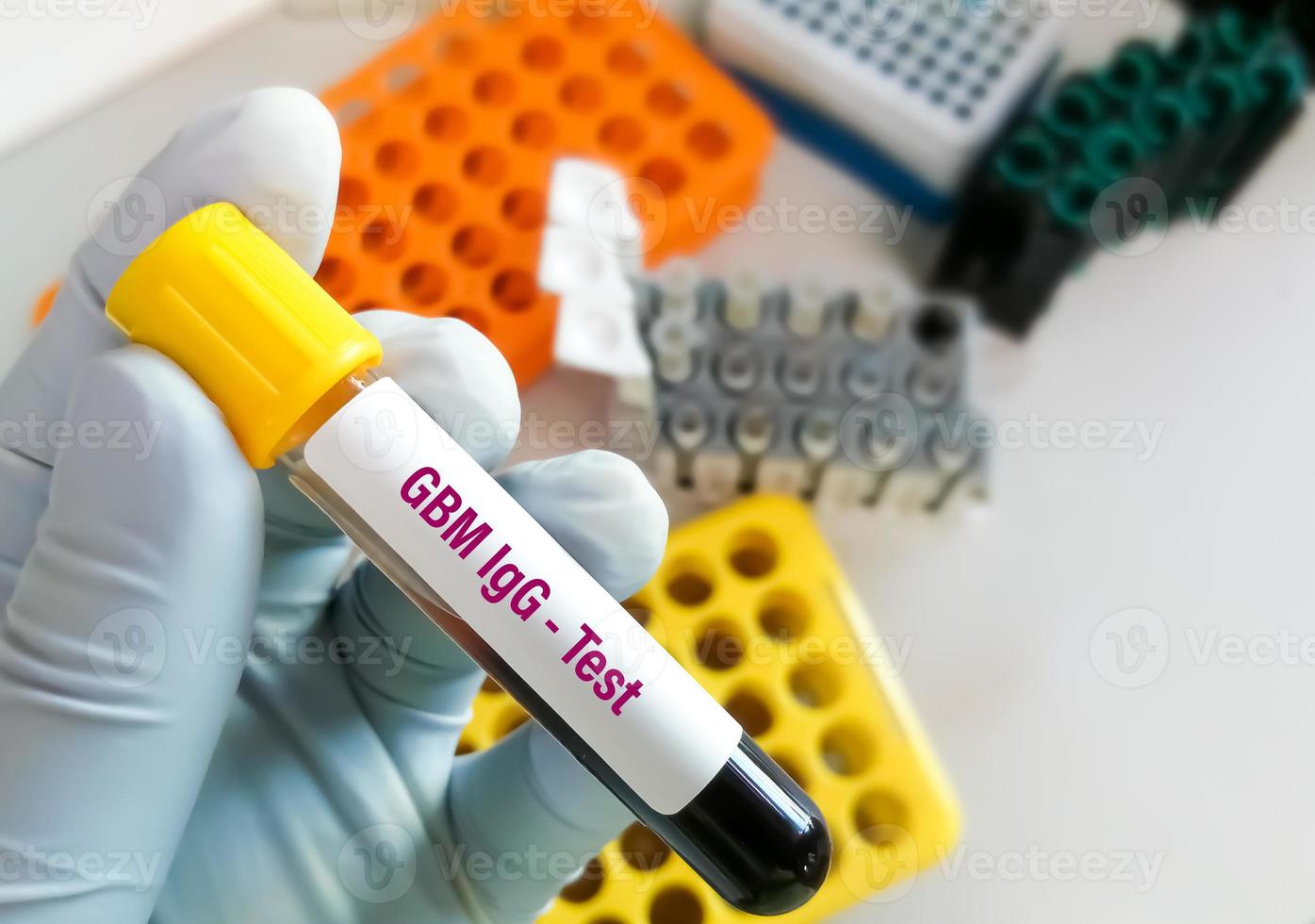 Glomerular Basement Membrane Antibody or GBM IgG test. photo