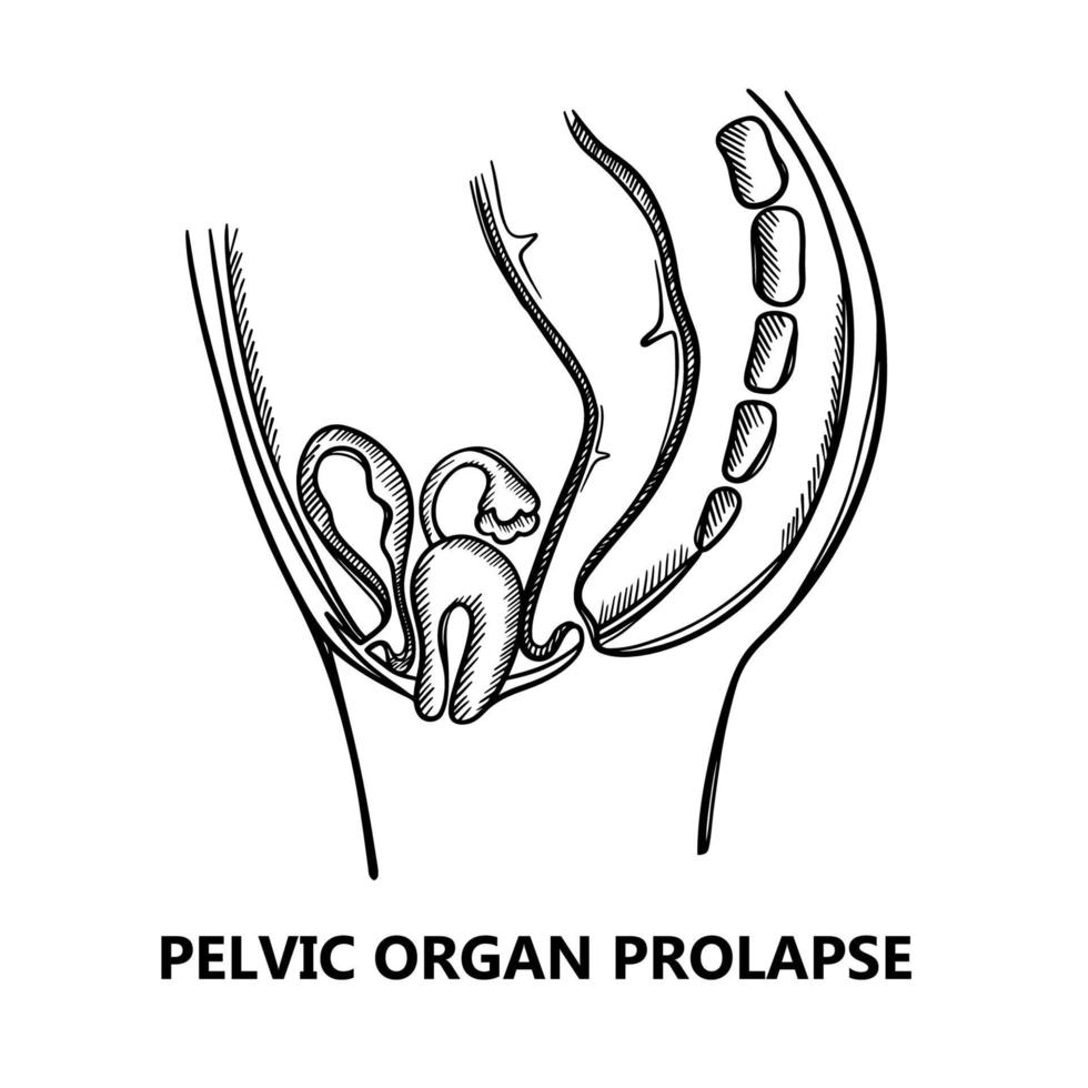 PELVIC ORGAN PROLAPSE SKETCH Education Scheme Vector Set