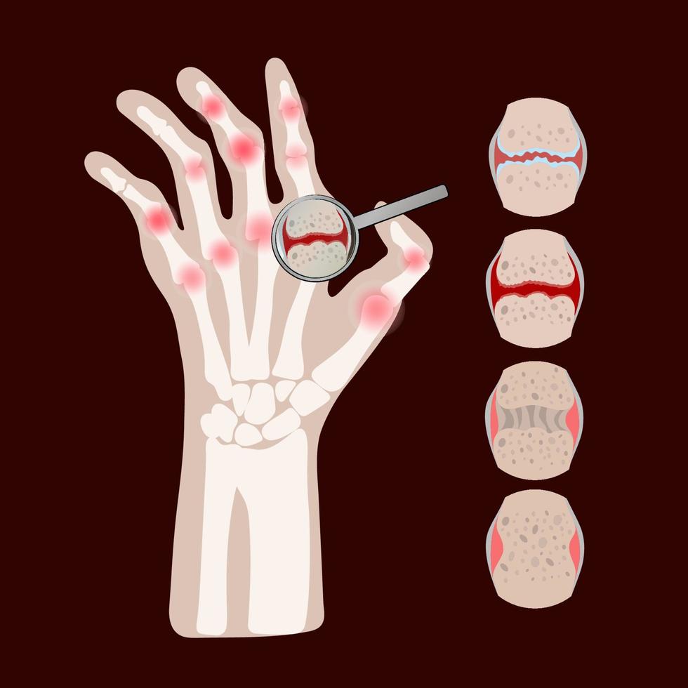 reumatoide enfermedad artritis medicina educación vector esquema
