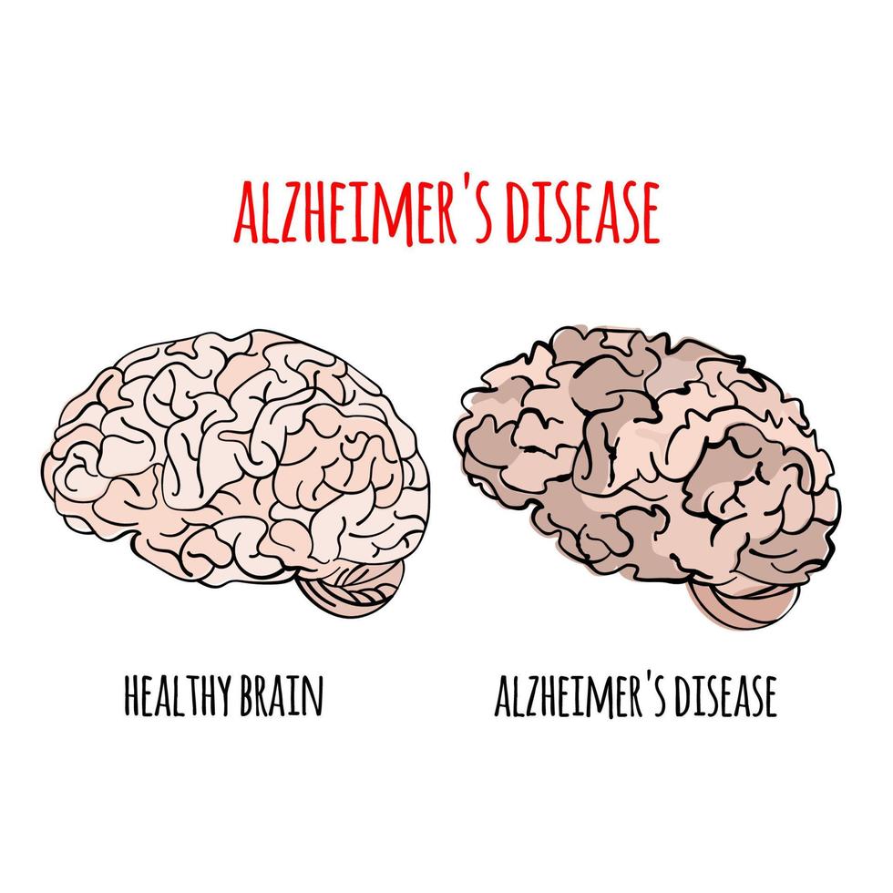 ALZHEIMER Disease Memory Loss Medicine Vector Illustration