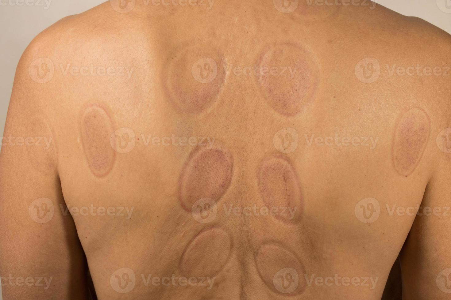 Mature man that had Cupping Therapy done on his back for pain relief photo
