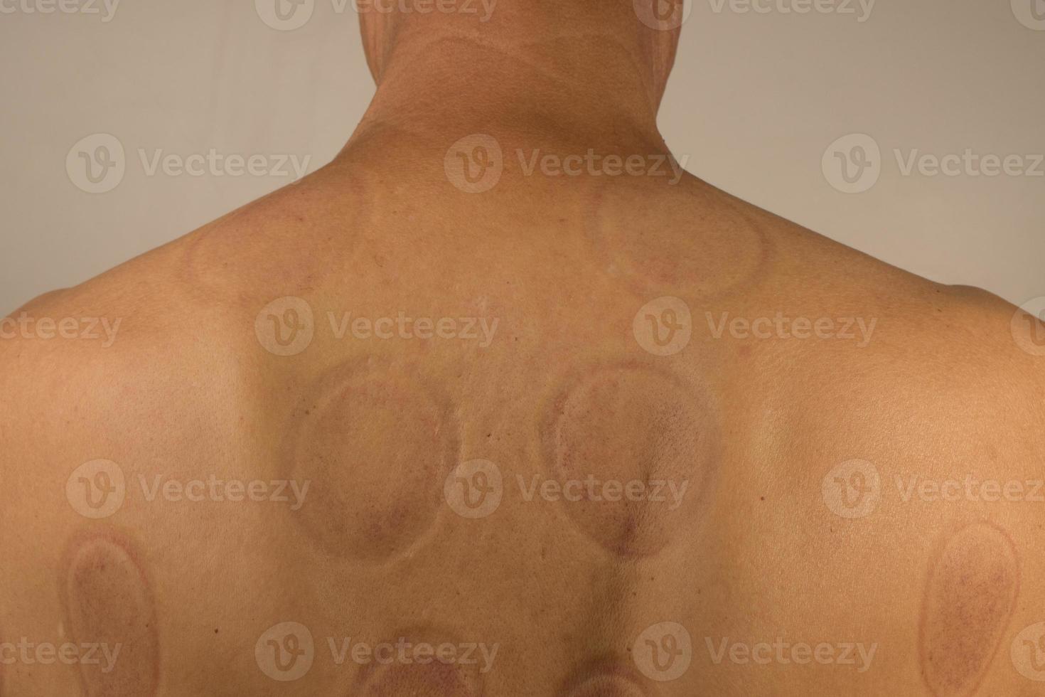 Mature man that had Cupping Therapy done on his back for pain relief photo