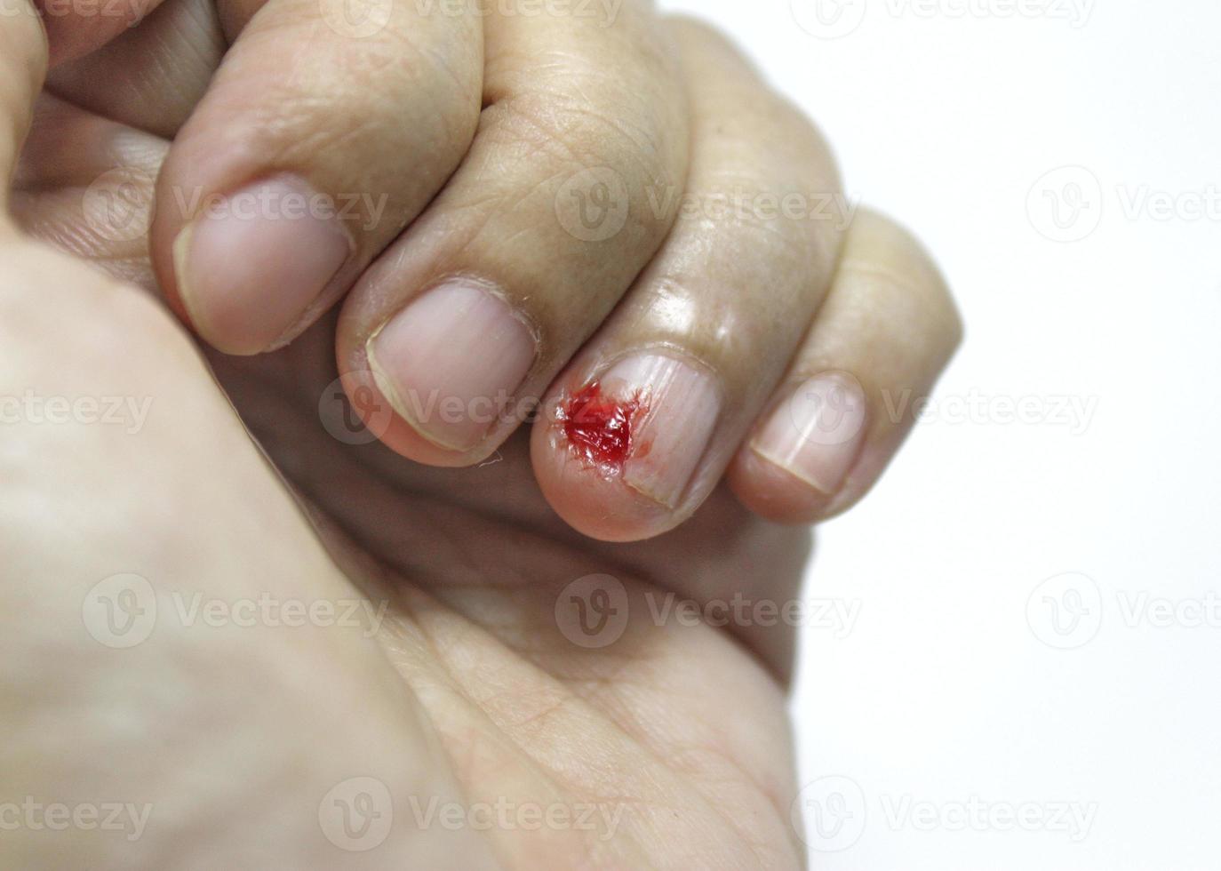 bleeding wound on finger at left hand with white background, bleeding on little finger, soft and blurry focus photo