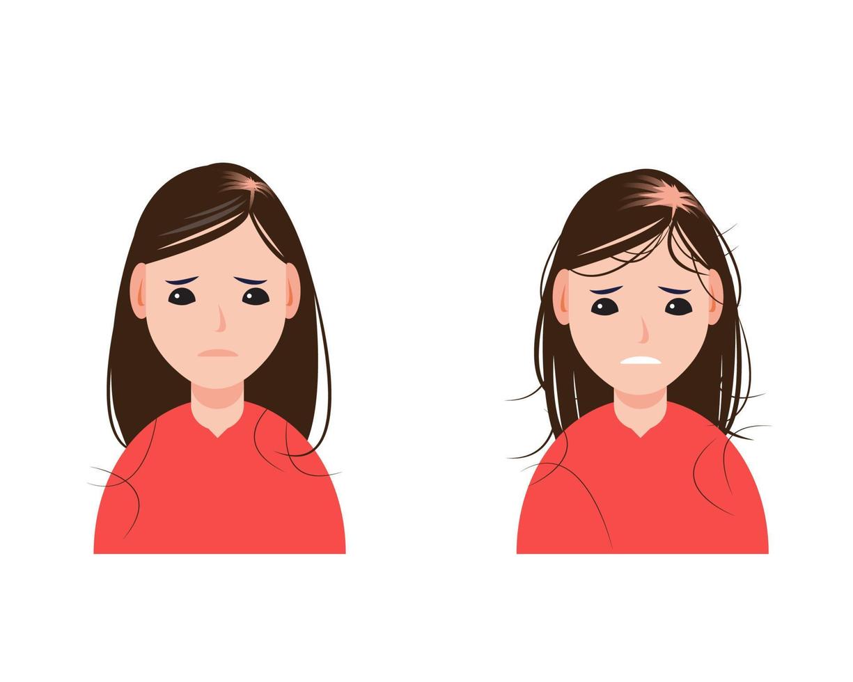 Female pattern baldness, alopecia, type of hair loss in women vector isolated on white background. Hair problem concept illustration.