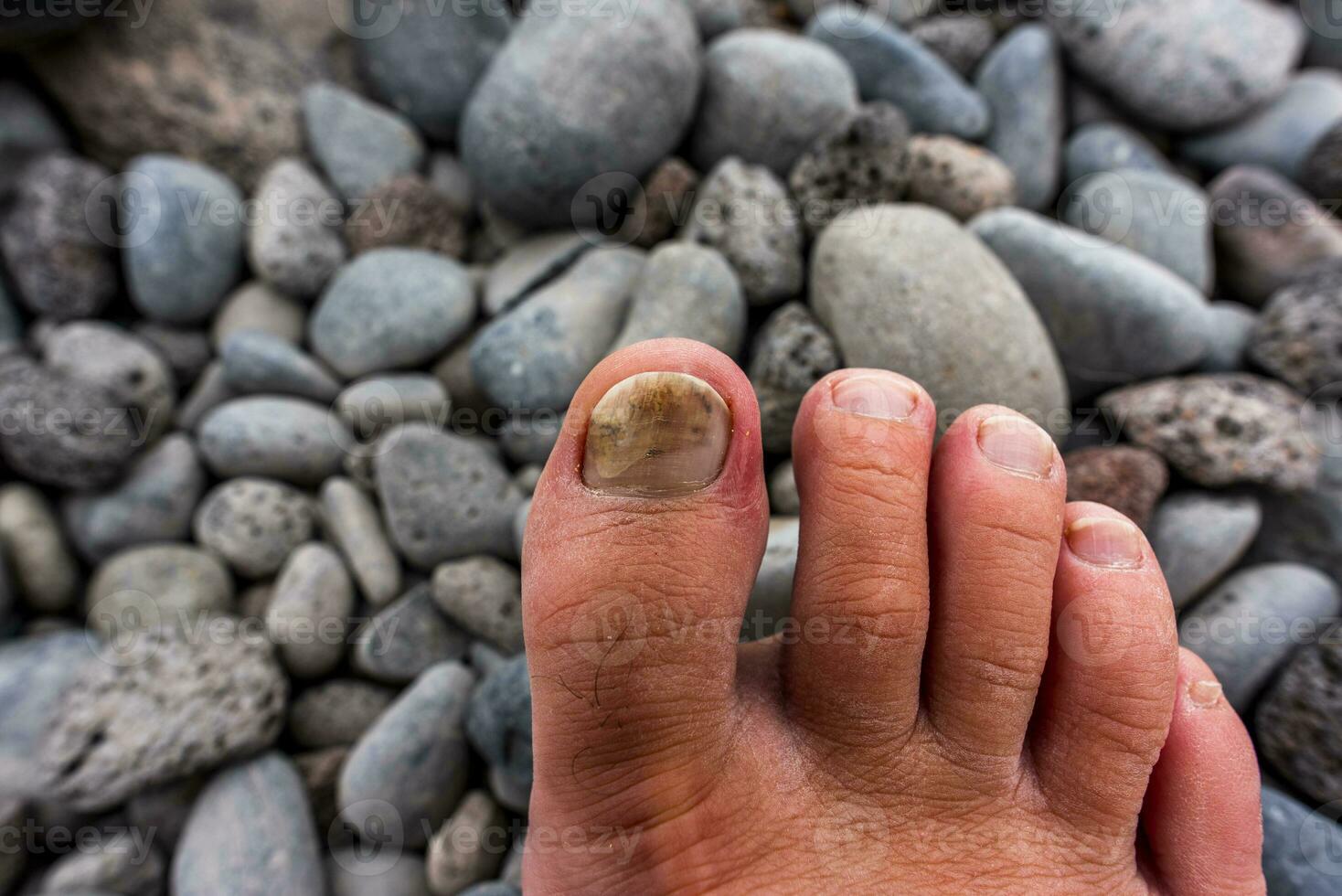 2022 08 24 Madeira crushed toe nail photo