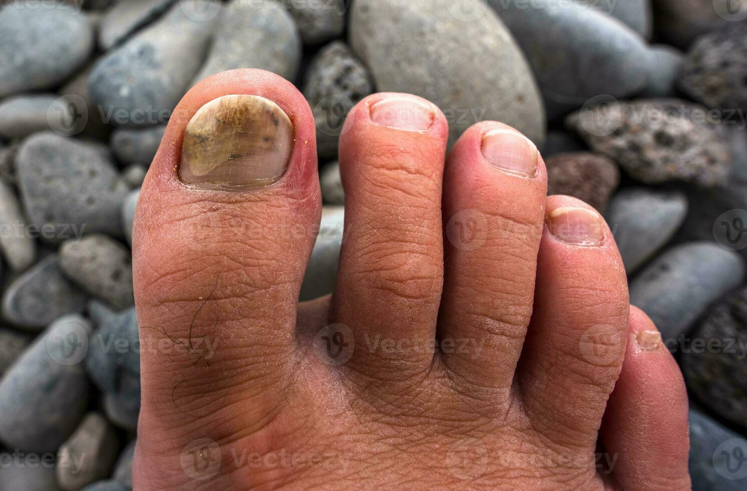 2022 08 24 Madeira crushed toe nail 1 photo