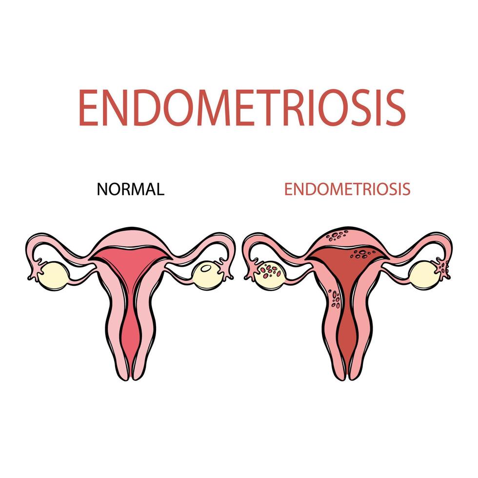 ENDOMETRIOSIS NORMAL FEMALE Reproductive System Education vector