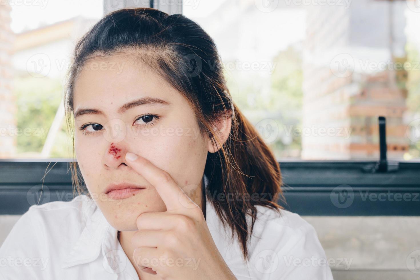 The Herpes simplex on asian woman nose, Herpes simplex is a viral