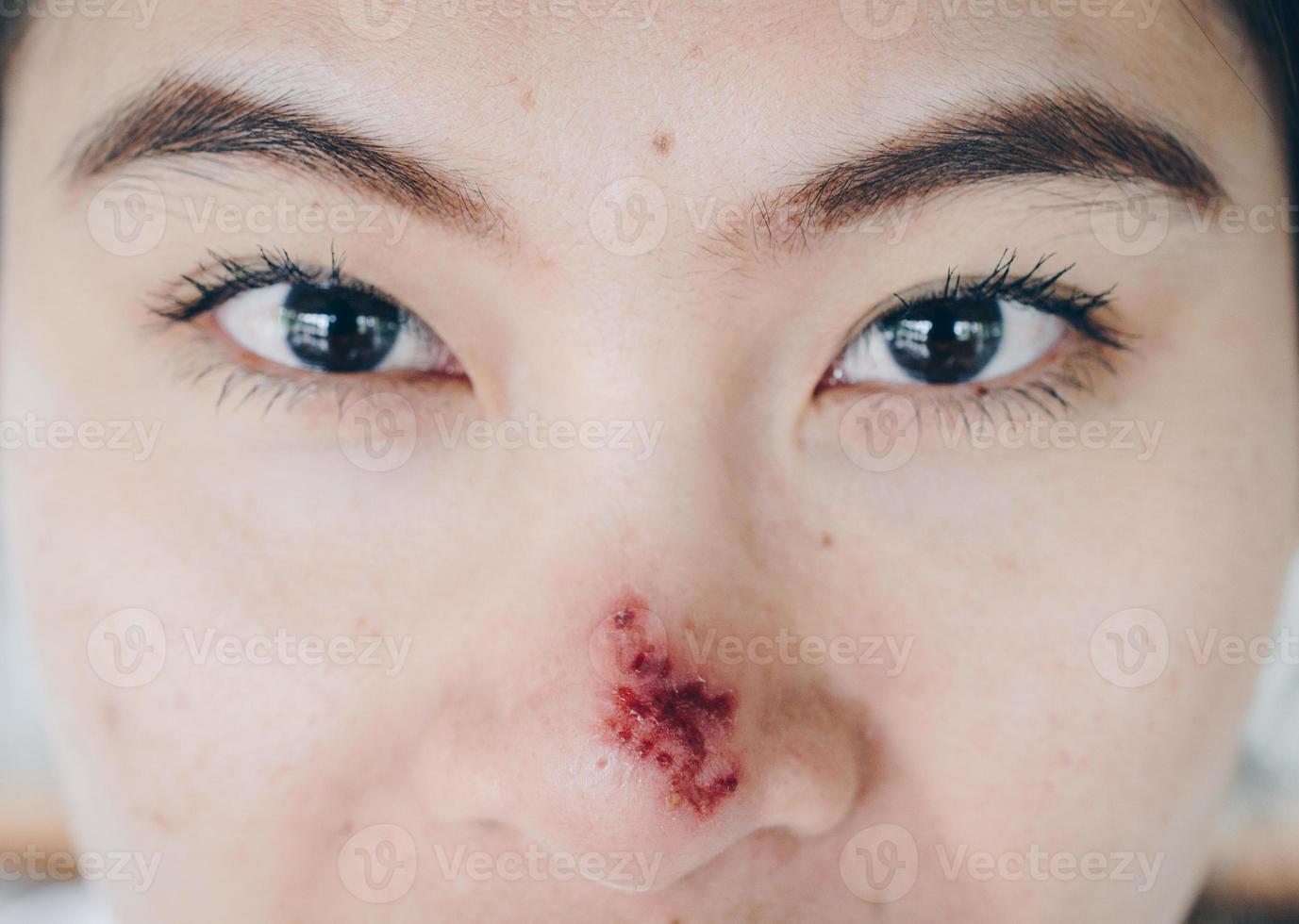 The Herpes simplex on asian woman nose, Herpes simplex is a viral disease caused by the herpes simplex virus. Infections are categorized based on the part of the body infected. photo
