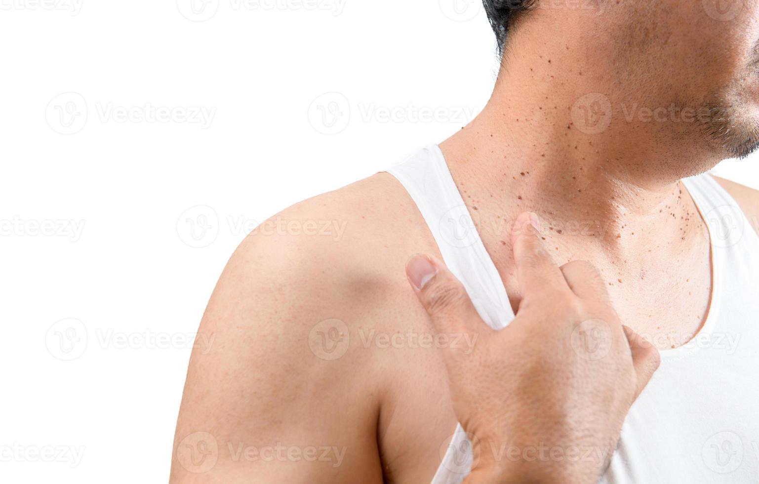medio Envejecido hombre en blanco ternera punto a piel etiquetas o acrocordón en su cuello foto