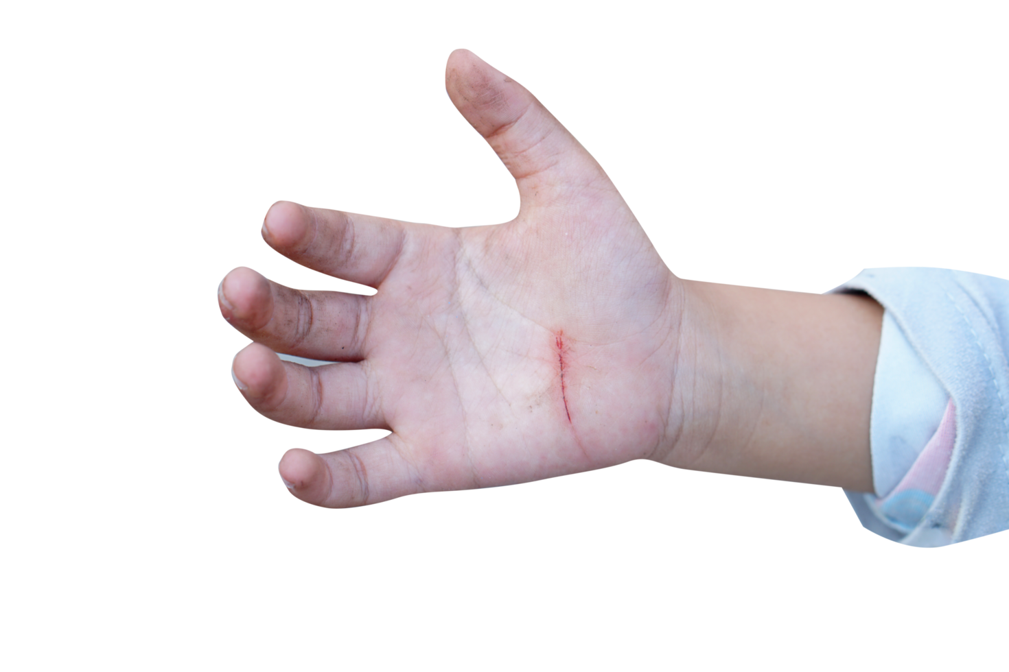 wound on a child's hand png