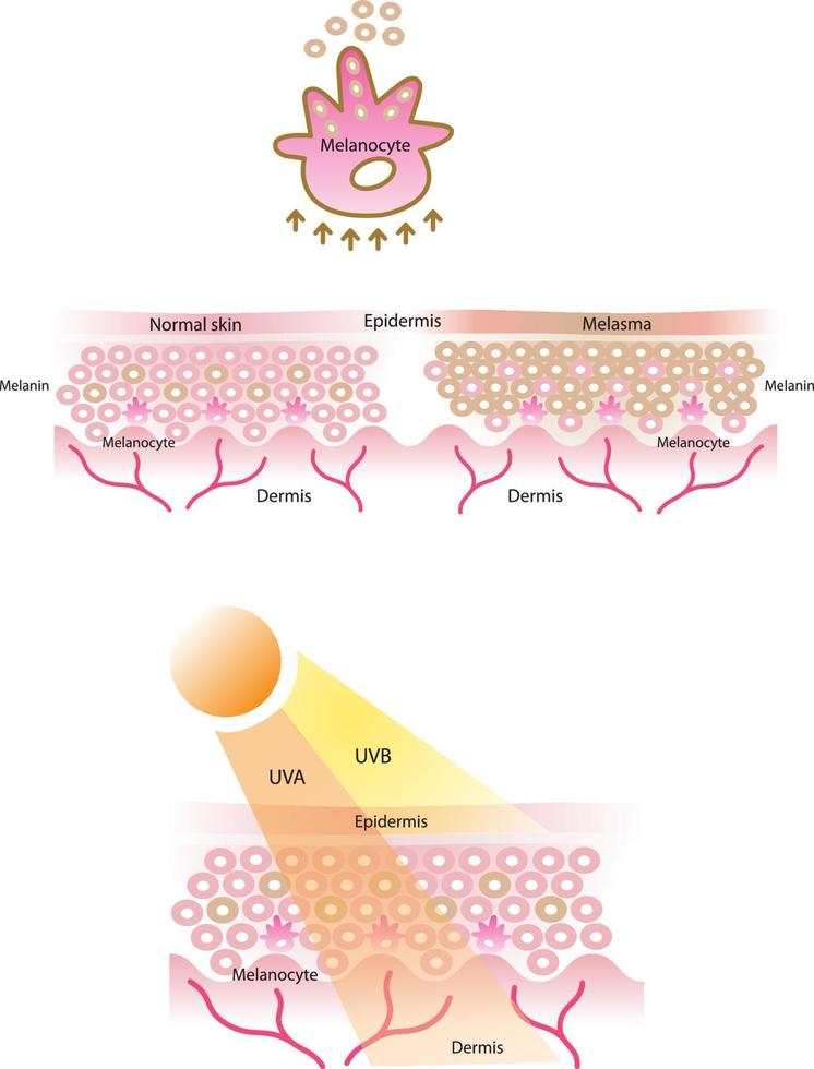 Melanocyte, melanin, melanogenesis vector and normal skin layer, melasma skin layer, skin layer with UVA and UVB on white background.