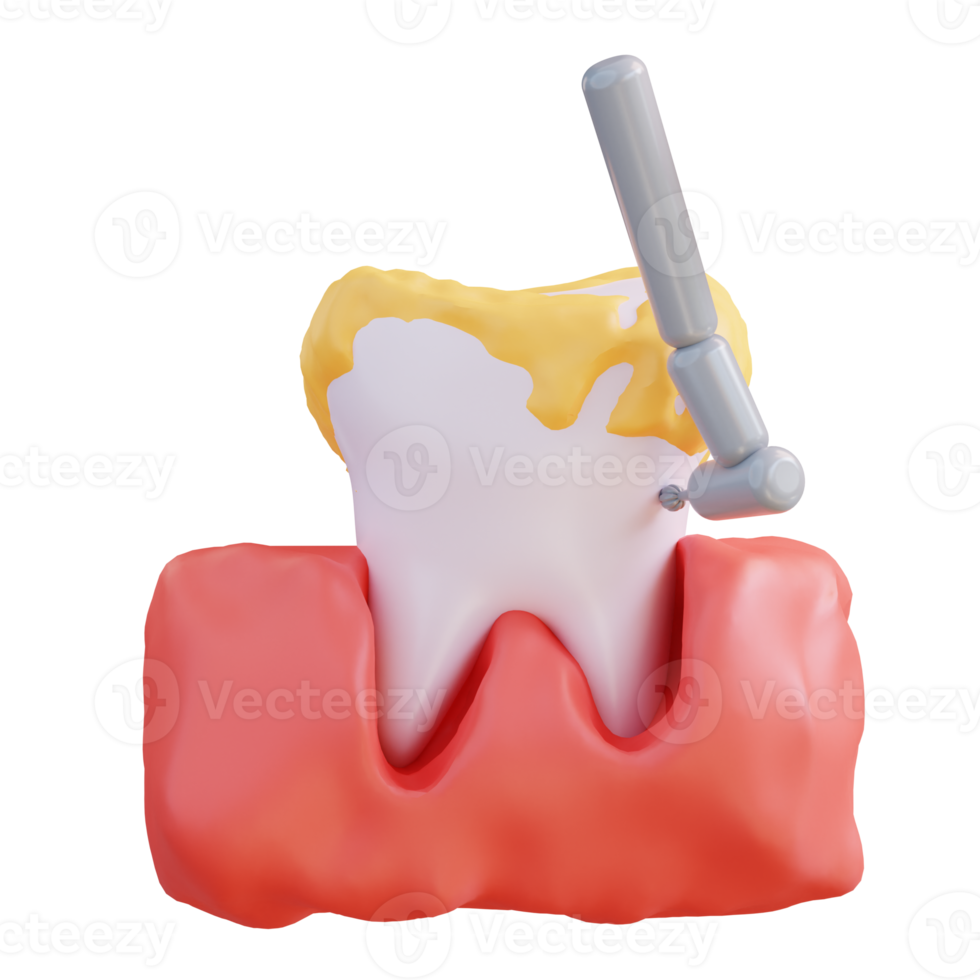 3d illustration av rengöring tartar med en dental borra png