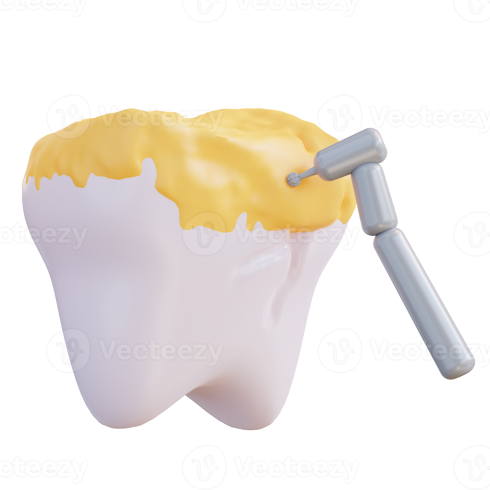 3d illustration of cleaning tooth decay with a drill png