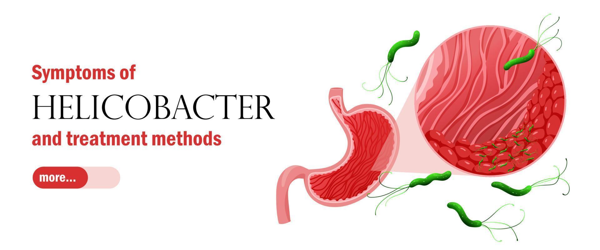 Web banner template with gastritis and helicobacter pylori. Healthcare vector illustration cartoon style