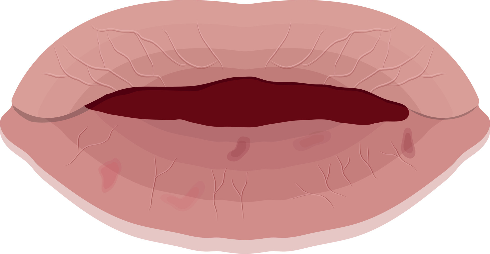 Dry Lips Vector Art, Icons, and Graphics for Free Download