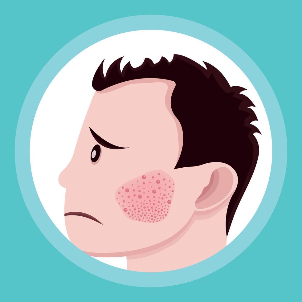 person with acne on the face vector