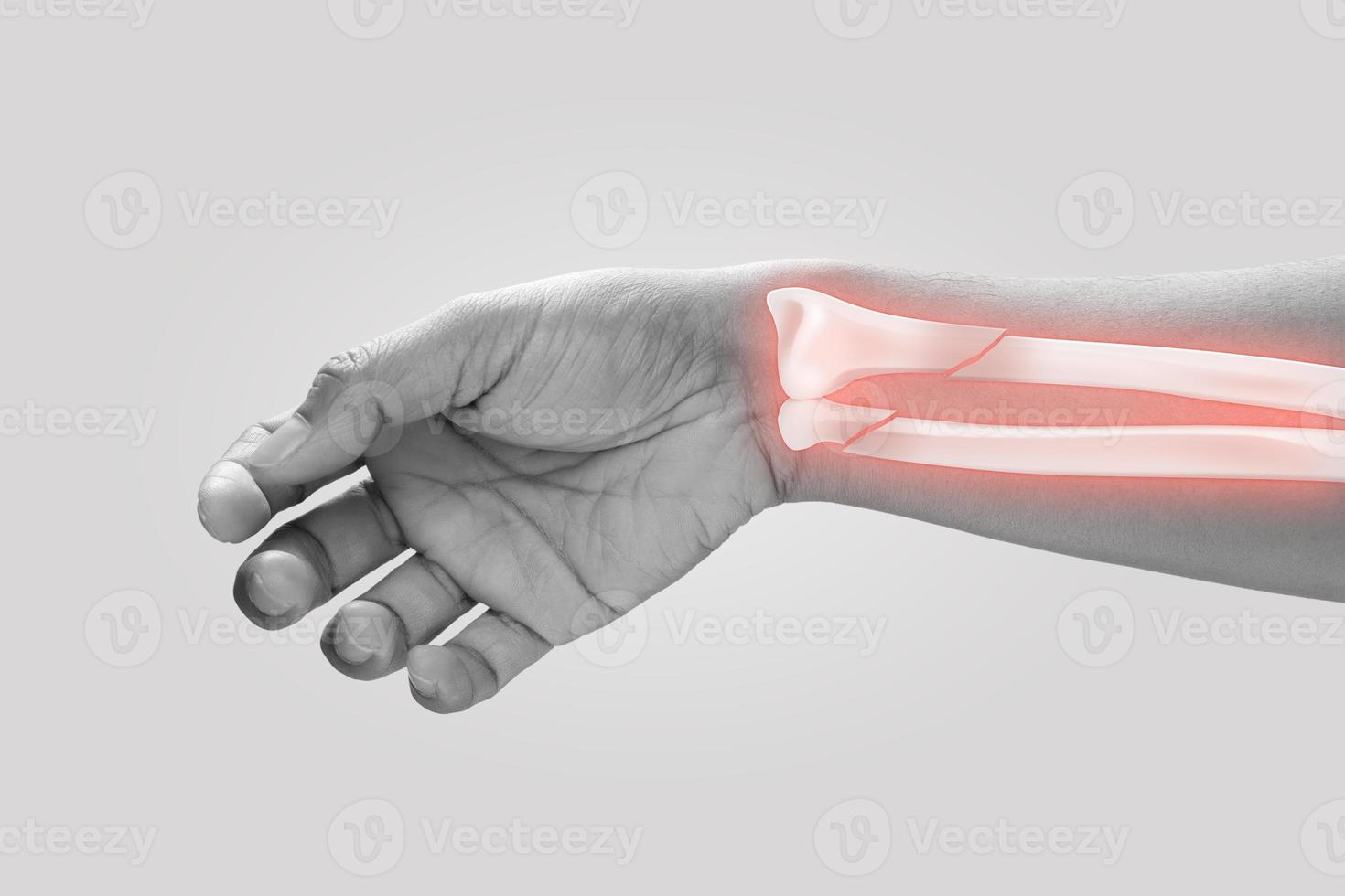 Men at higher risk of wrist fractures. Pain concept photo