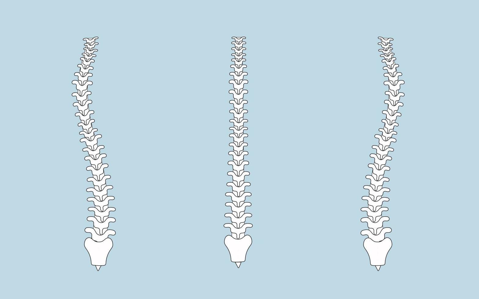 human spine in normal and with scoliosis vector