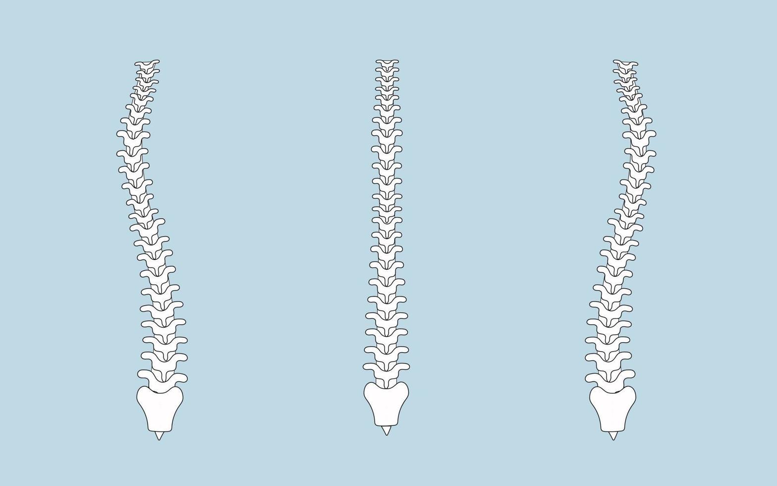 humano espina en normal y con escoliosis vector