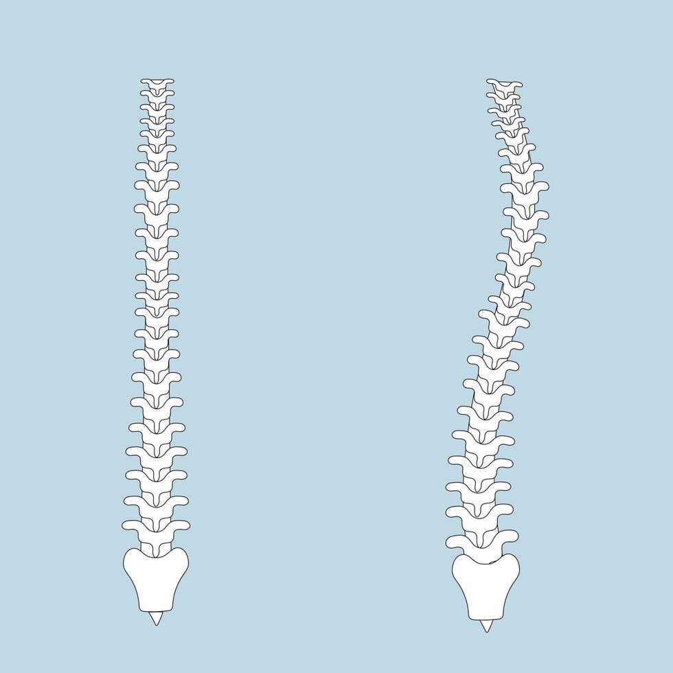 humano espina en normal y con escoliosis vector